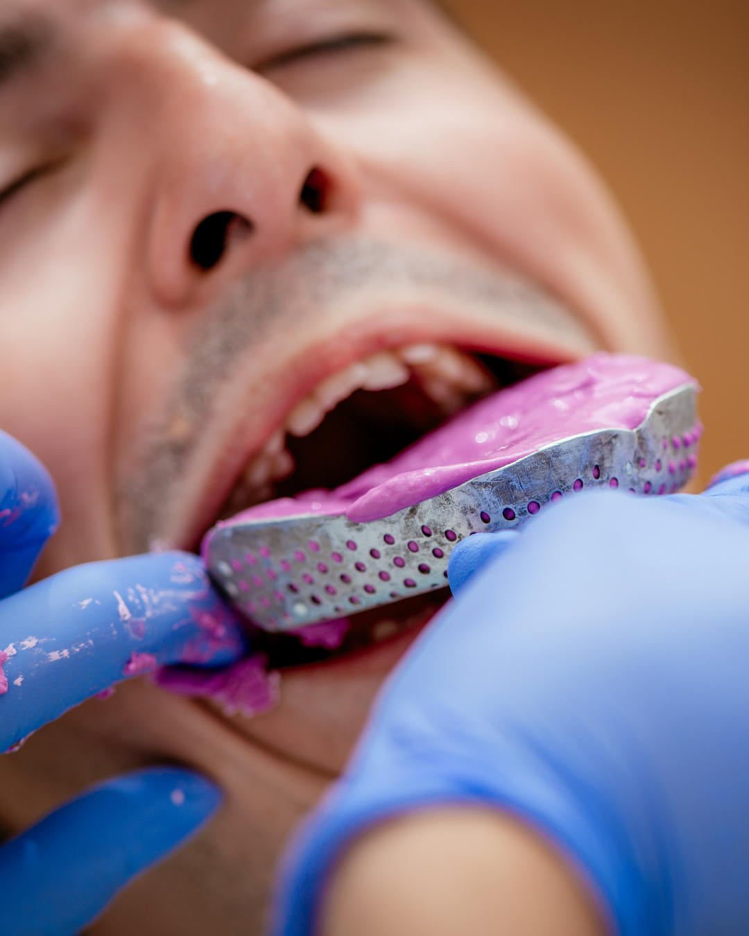 Dental Impression